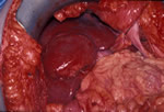 A residual abnormality in segments 5 and 6 of the right hemi-liver