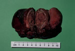 The final pathology confirmed the underlying abnormality