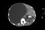 Massive liver cyst - ct scan